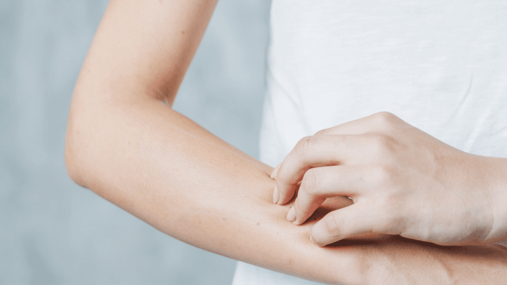 Eczema