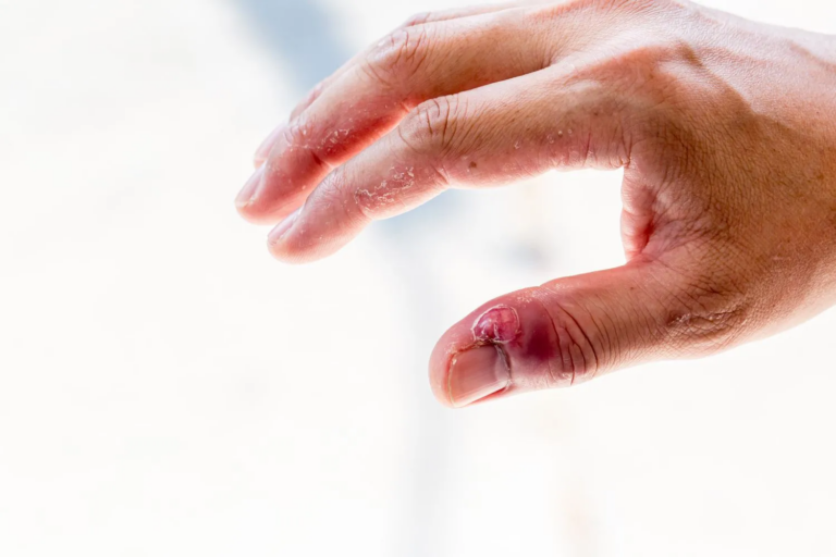 Localized Scleroderma