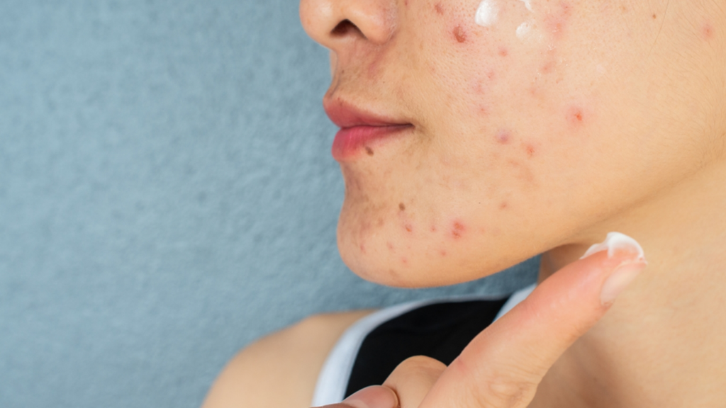 acne