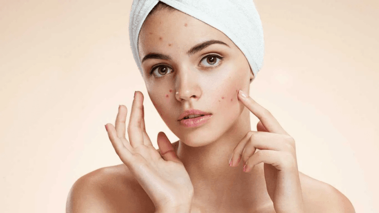 Discover the 7 Types of Acne: A Comprehensive Guide