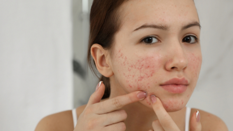 Unleash the Power of Hormones: Discover the Root Causes of Acne