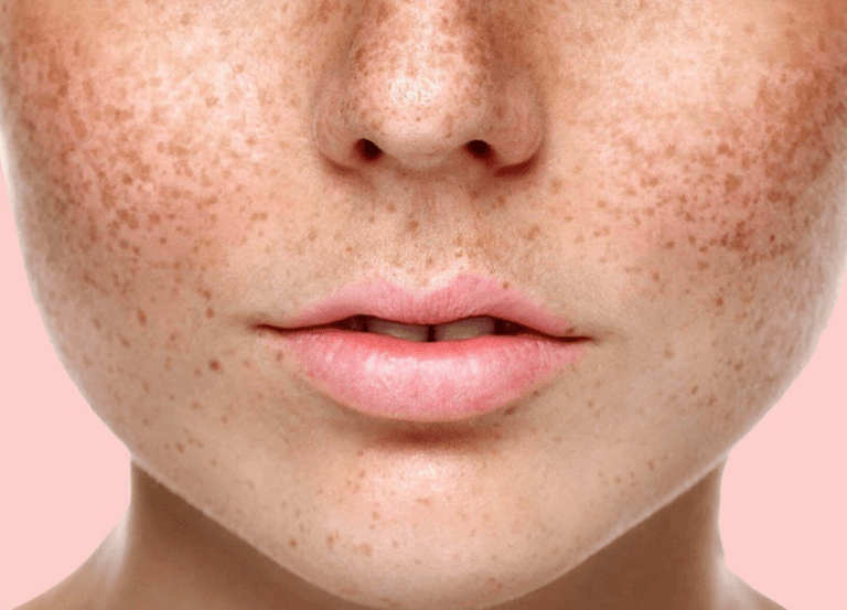 Фотография лица человека крупным планом, на коже которой видны следы от прыщей.