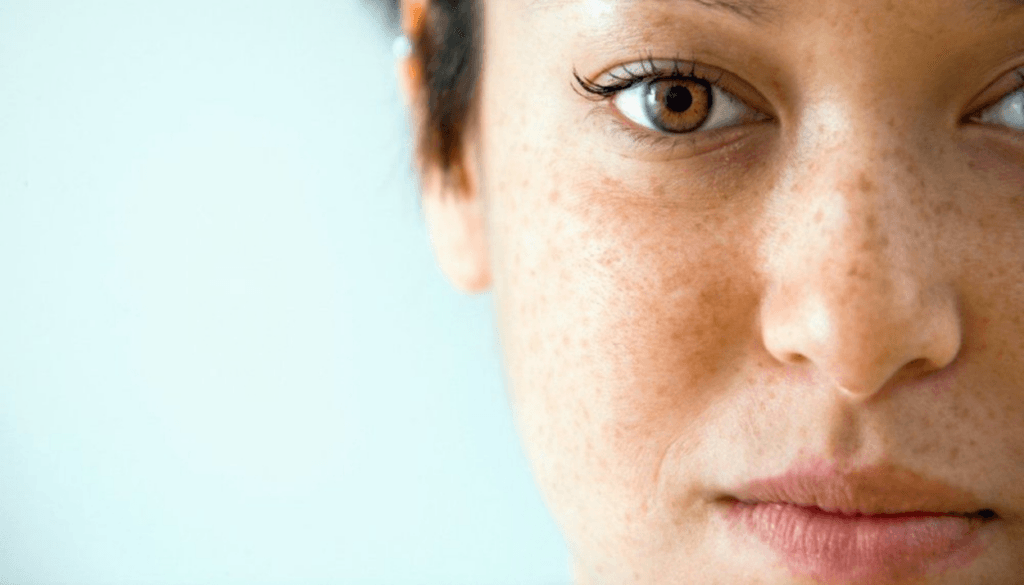¿Puede el limón eliminar el melasma?
