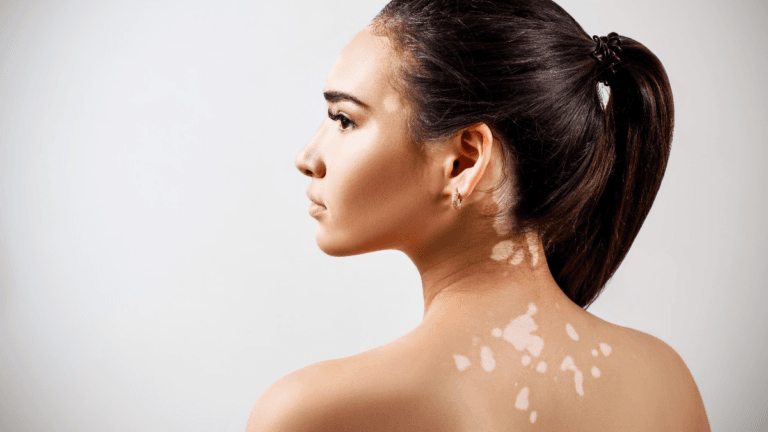 Показания к хирургическому лечению витилиго и отбор пациентов