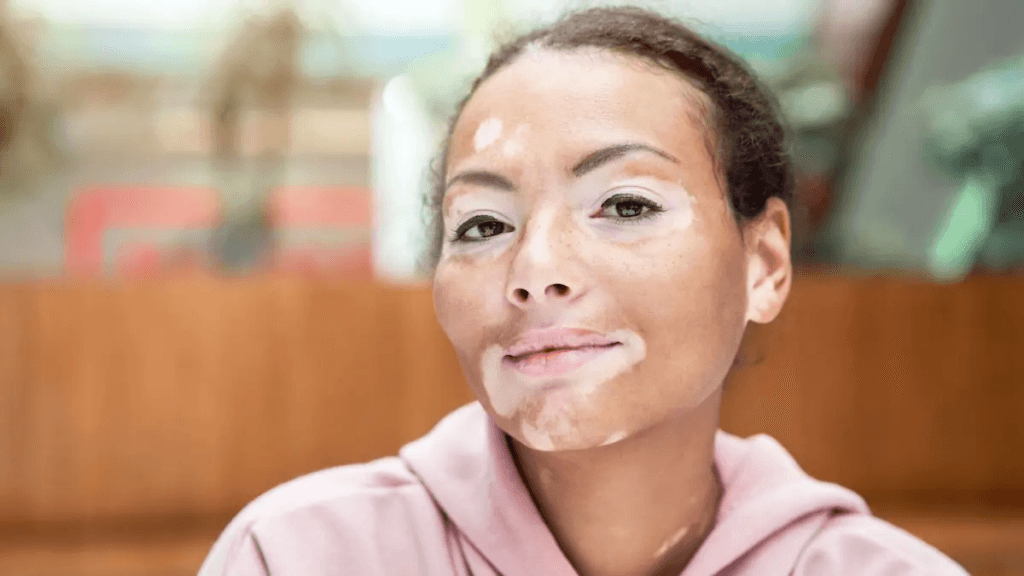Vitiligo Cerrahisinin Temellerini Anlamak