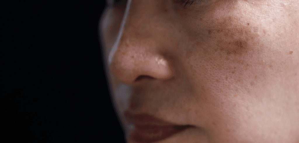 A close-up photograph of a person's face showing visible acne marks and skin imperfections.