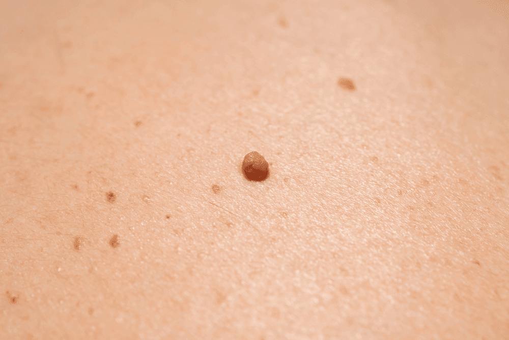 Cost-Effective Skin Tag Removal in Antalya