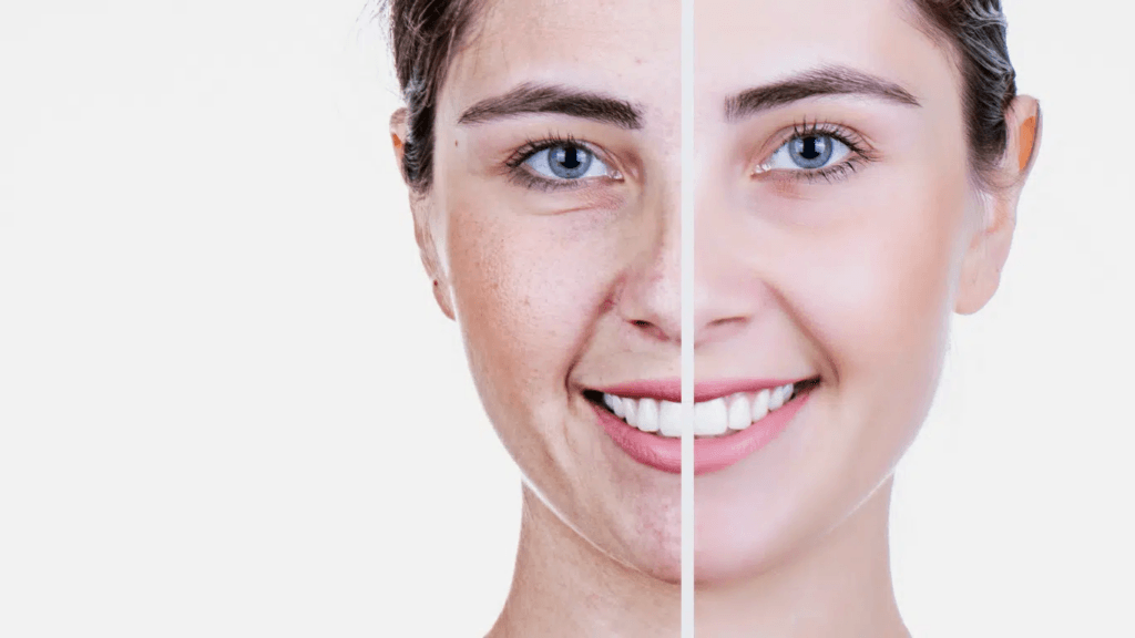 El coste de los tratamientos antienvejecimiento: Botox y Rellenos en Antalya