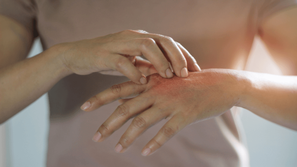 Traiter le psoriasis à Antalya : Options de traitement et coûts
