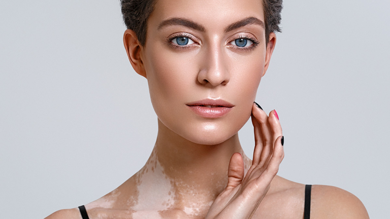 Предоперационные соображения при хирургическом лечении витилиго