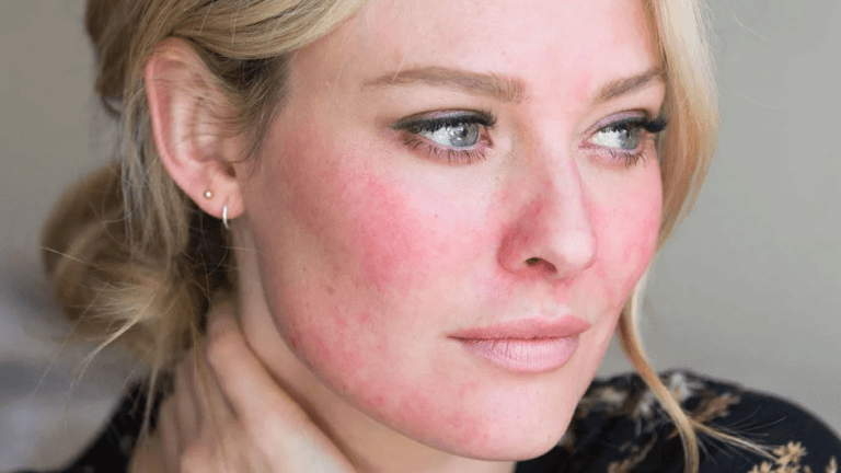 Экономически эффективные методы лечения розацеа в Анталии