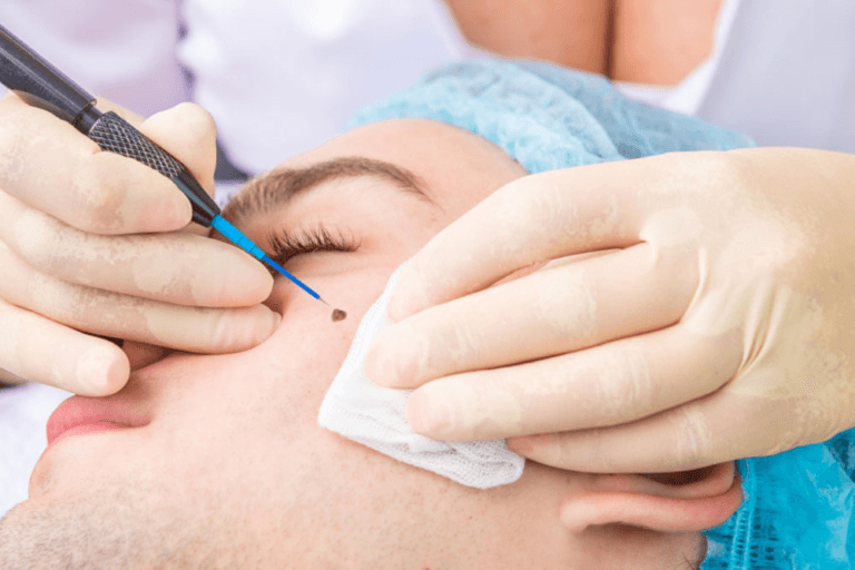 A doctor performing a minor surgical procedure on a patient's face using a scalpel and forceps. The patient is lying down with their face exposed, and the doctor is wearing gloves and a surgical cap.