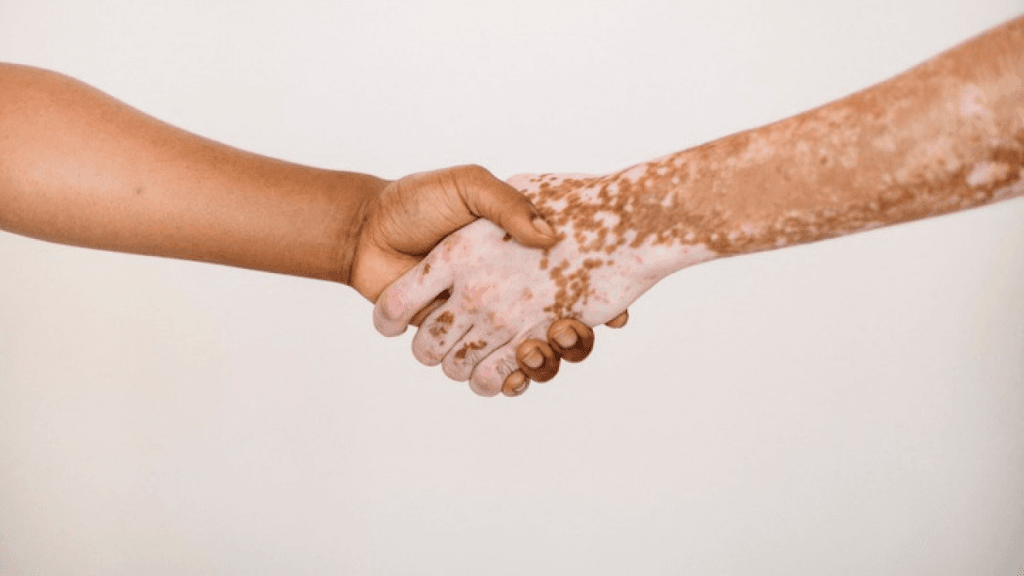 Complications and Risks Associated with Vitiligo Surgery