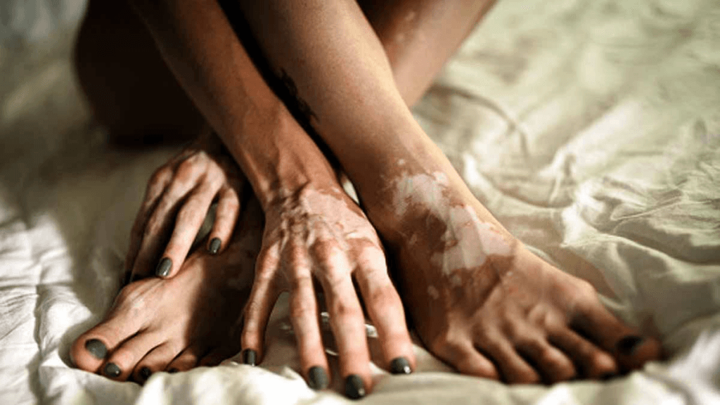 A person with vitiligo is lying on a bed, showcasing the patches of lighter skin on their hands and feet.