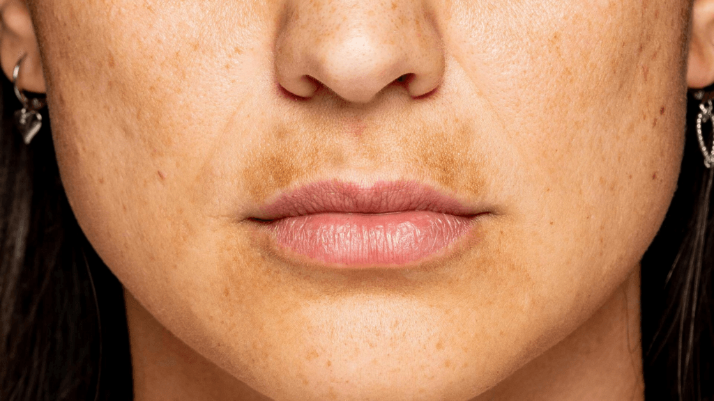 Fotografía en primer plano del rostro de una persona, con énfasis en los labios y la piel circundante. La persona tiene la piel clara con imperfecciones y pecas visibles. Los labios están ligeramente separados y parecen ser de un color rosado natural. Lleva pendientes grandes y colgantes, y su cabello, oscuro y liso, enmarca el rostro a ambos lados.