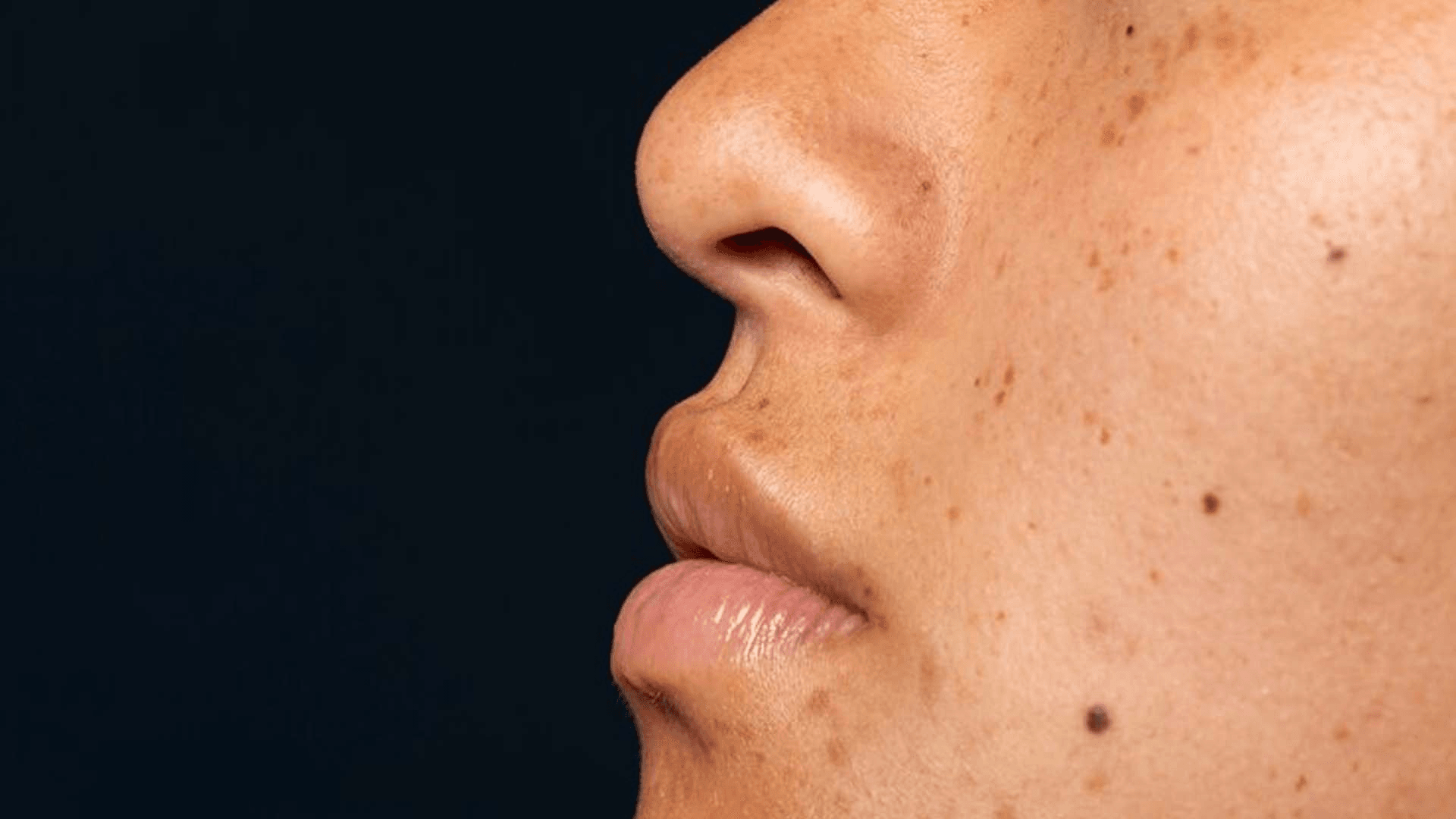 Can dark spots be removed permanently? - Dr Ebru Okyay - Dermatologist ...