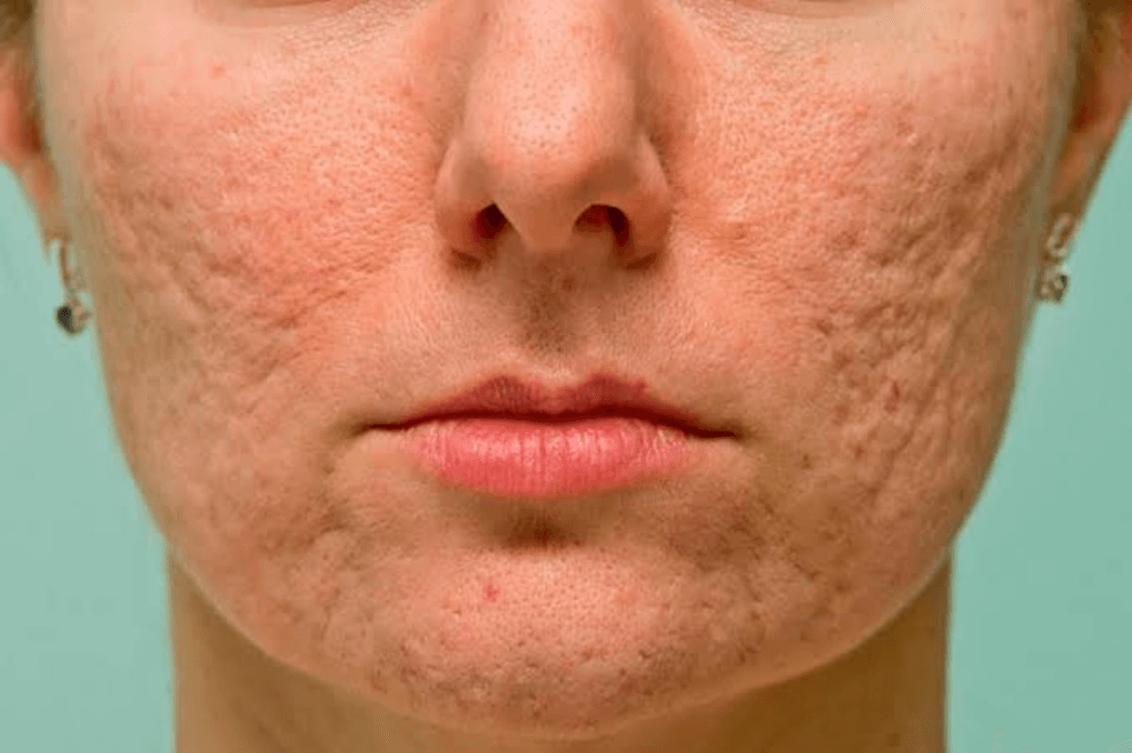 Quale trattamento è più indicato per le cicatrici da acne?