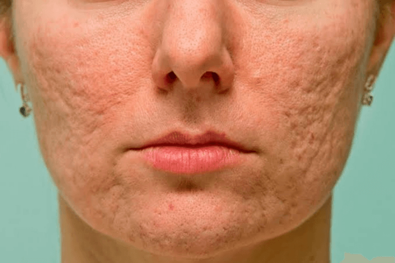 What skincare is best for acne scarring?
