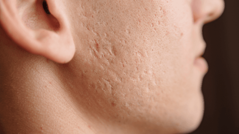 A close-up image of a person's face focusing on the neck and jawline, showing visible acne marks and skin texture.