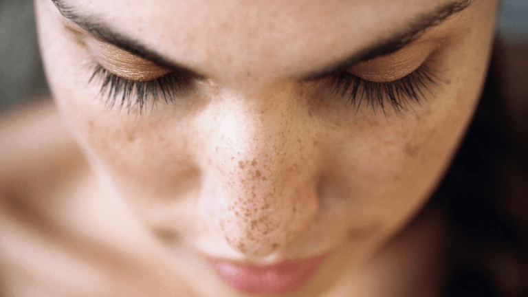 What procedure is best for dark spots?