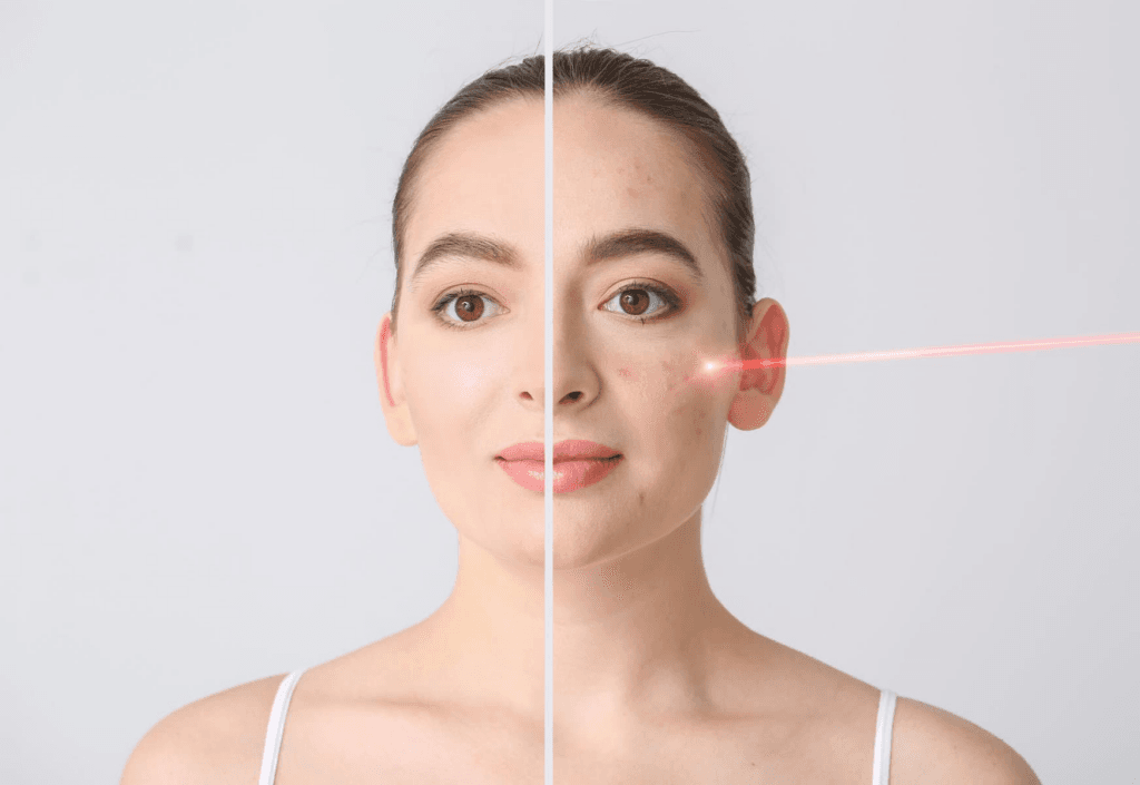 ¿El láser facial tiene efectos secundarios?