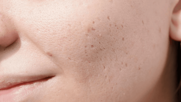 A close-up image of a person's face with visible acne on the cheek and jawline.