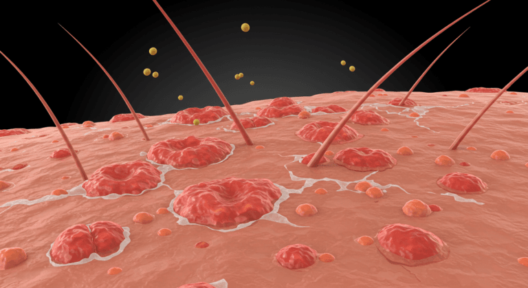Грибковые инфекции