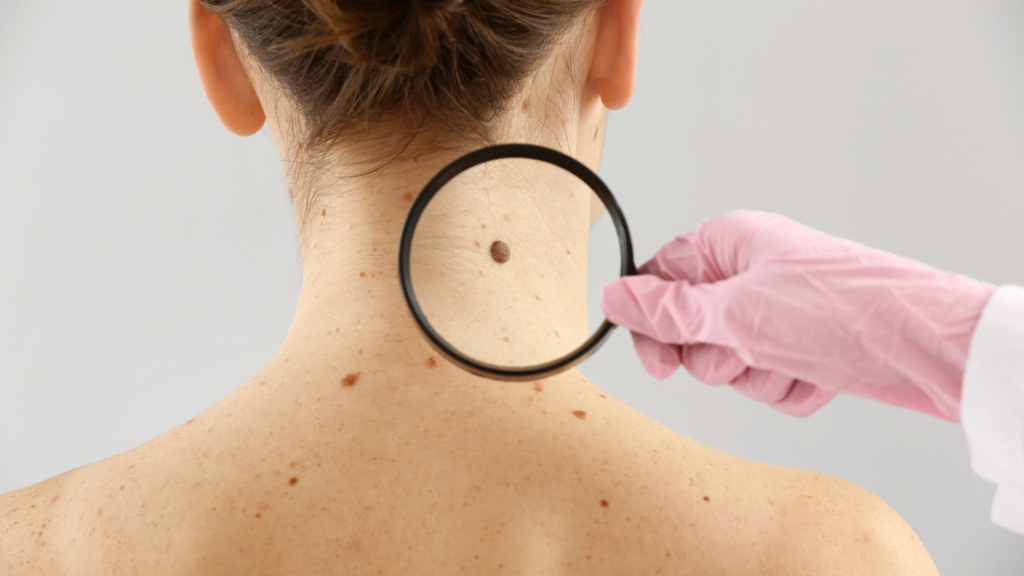 A doctor examines a patient's back for moles using a magnifying glass.
