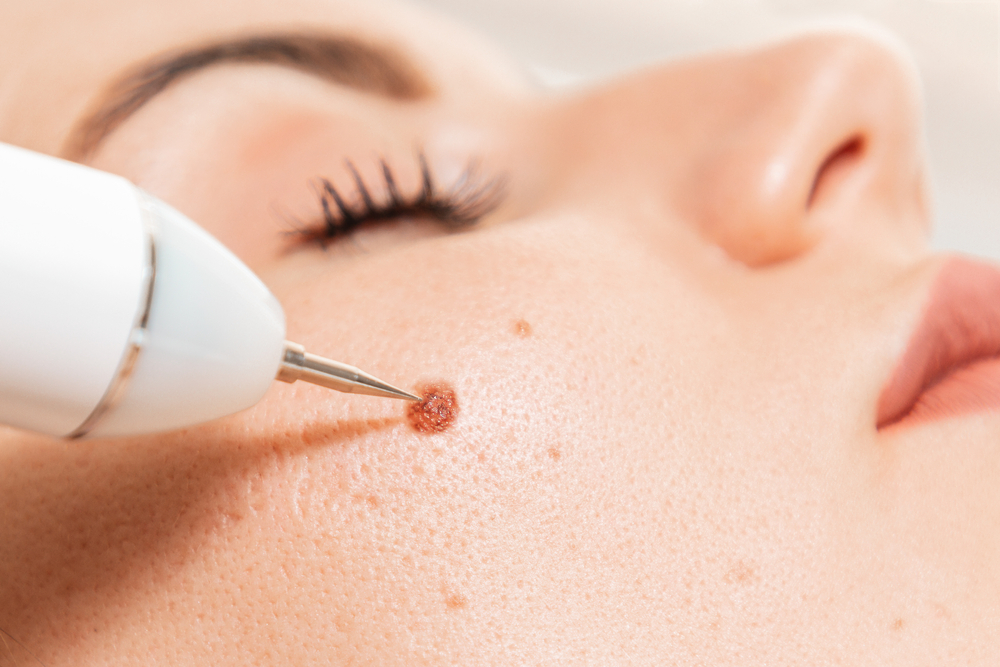 Understanding Anesthesia and Recovery for Surgical Mole Removal
