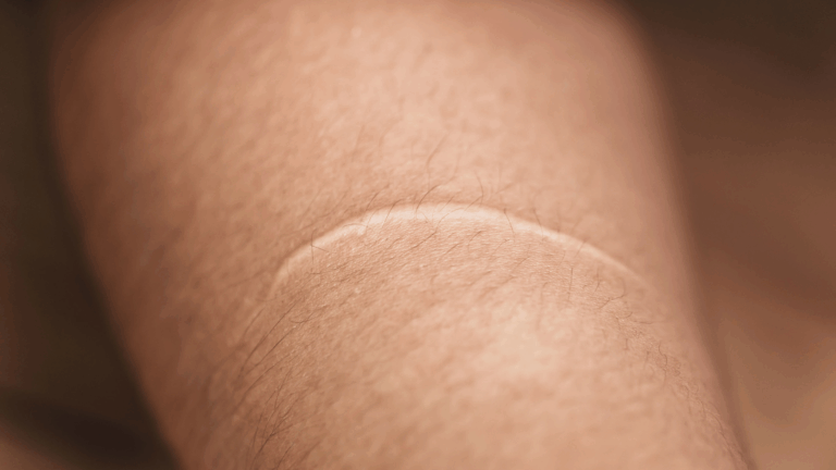 A close-up image of a person's elbow showing dry, flaky skin.