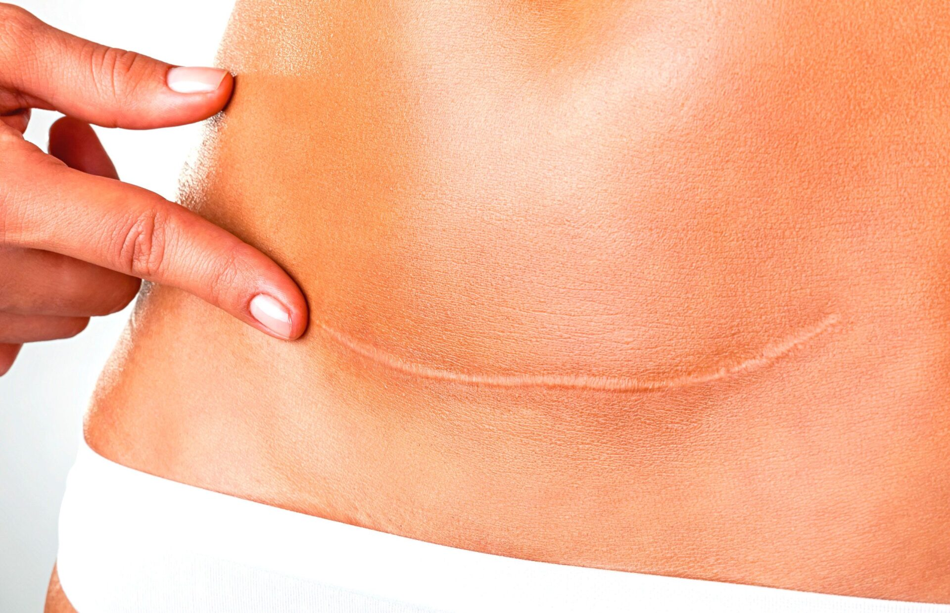 Scar Revision: Best Surgical Approach